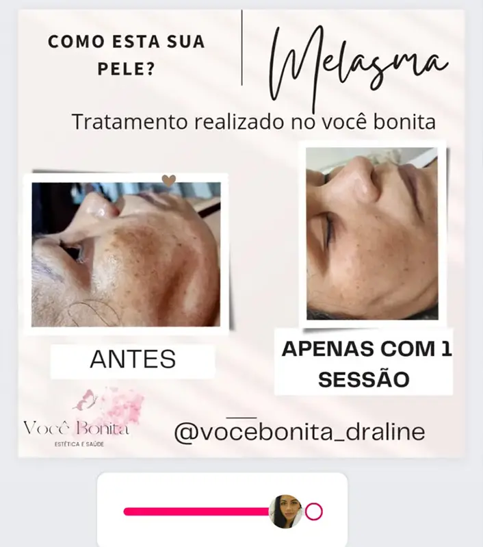 Resultado real Instituto Você Bonita 1